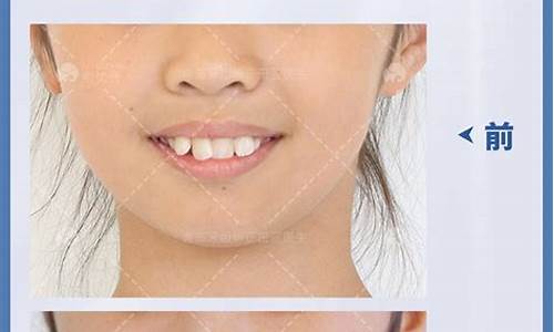 幼儿牙齿矫正最佳时机是什么时候
