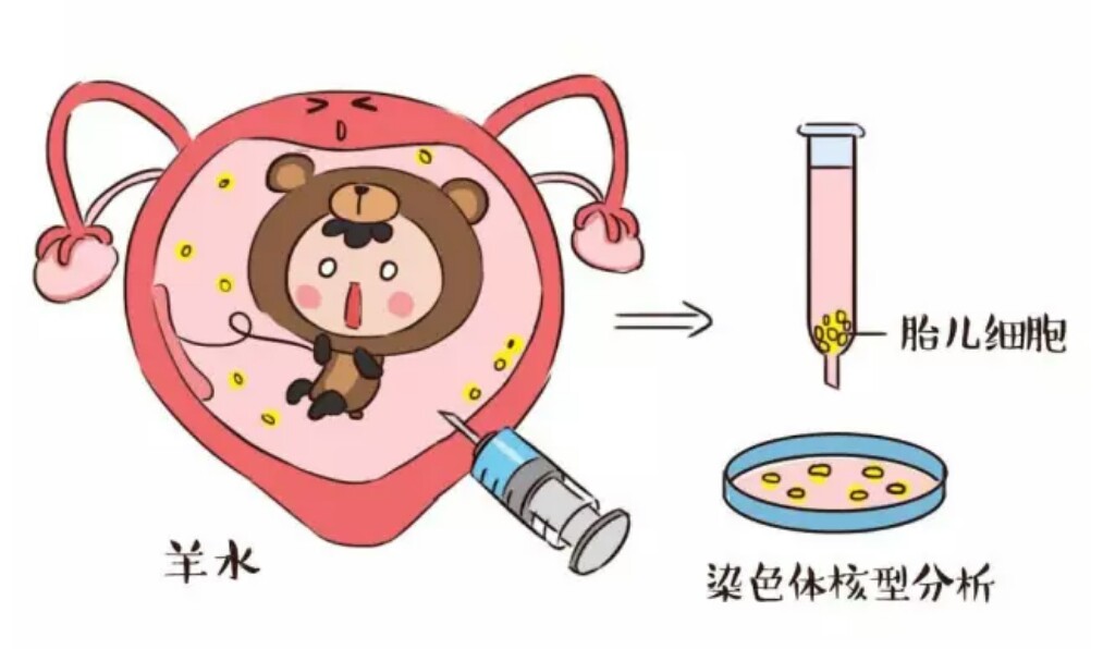 ﻿无创产前基因检测是检查什么